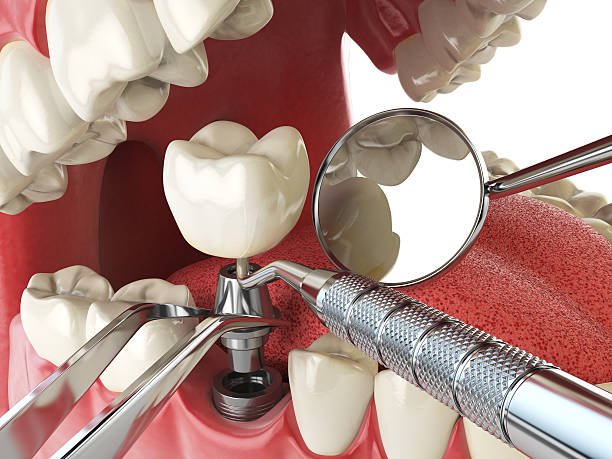 Best Knocked-Out Tooth Emergency  in Mayfield, PA